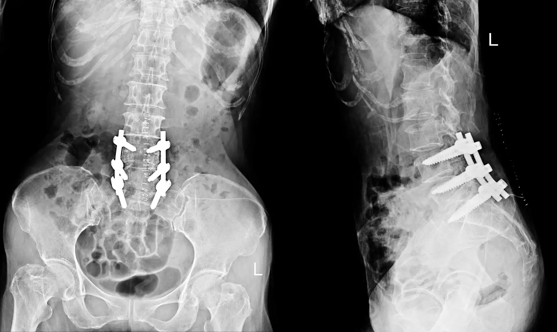 Spinal Cord Accident